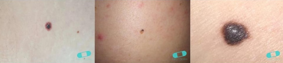 melanoma_first_derm.jpg